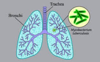 Transforming Tuberculosis Preventive Treatment