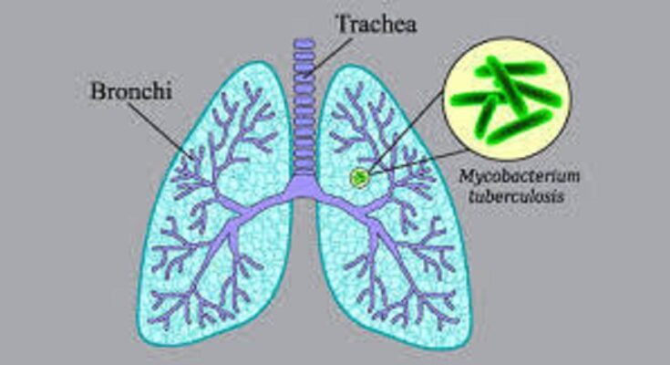 Transforming Tuberculosis Preventive Treatment